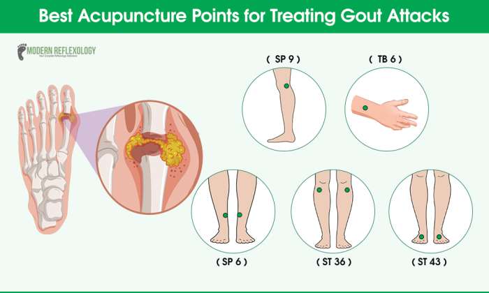 Acupuncture Points for Treating Gout Attacks