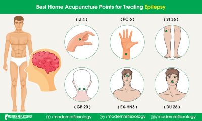 Acupuncture Points for Treating Epilepsy