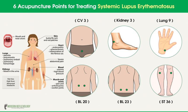 Acupuncture Points for Treating Systemic Lupus Erythematosus