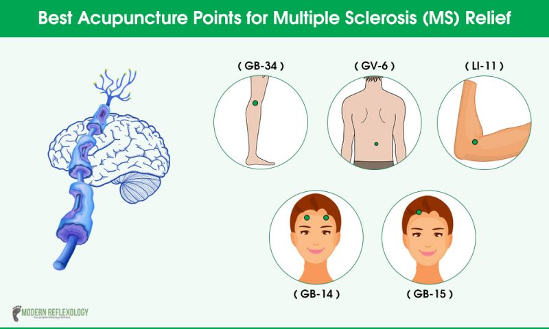 Acupuncture Points for Multiple Sclerosis (MS) Relief