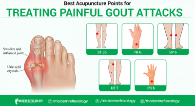 Treating Gout Attacks