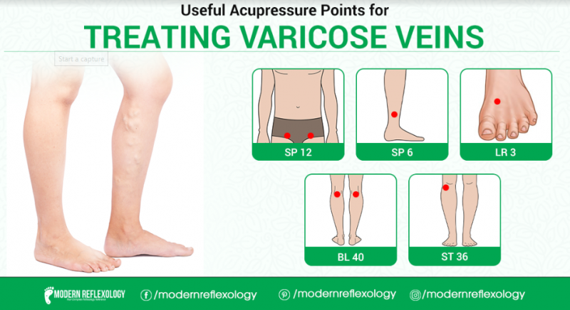 Treating Varicose Veins