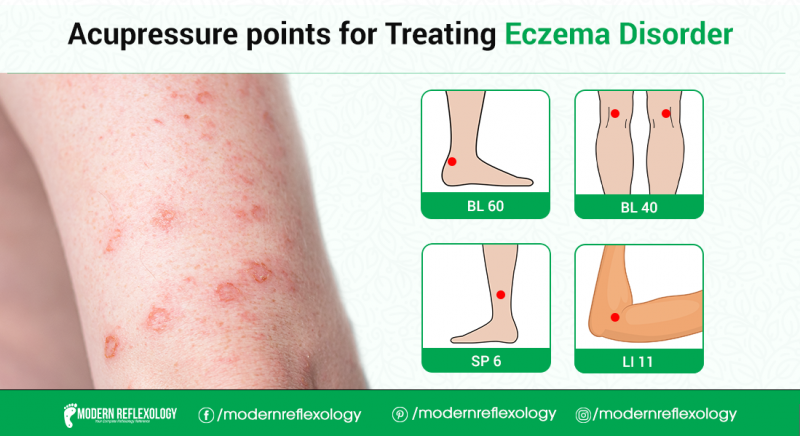 Eczema